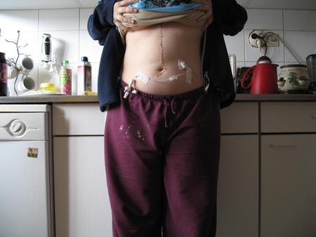 10 days post-op